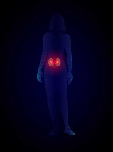 Lithotripsy illustration