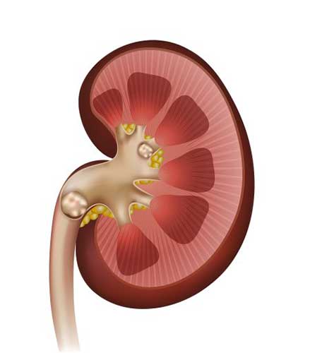 Kidney Stones Illustration