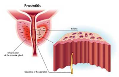 Prostatitis Nashville